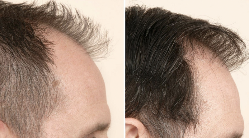 Calvicie en Medellín