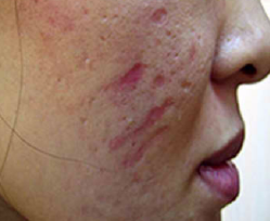 Dermapen Medellin para cicatrices tratamiento 07