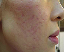 Dermapen Medellin para cicatrices tratamiento 08