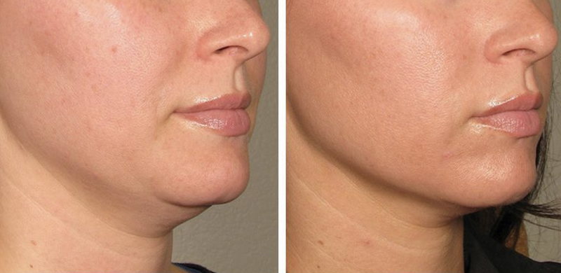 Eliminación de Papada Medellín