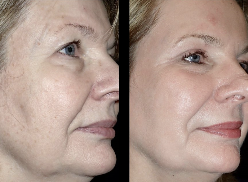 Hilos de sostén facial Medellín