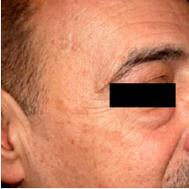 IPL luz pulsada intensa Medellin 02