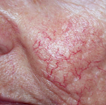 IPL luz pulsada intensa en Medellin 07