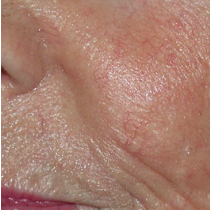 IPL luz pulsada intensa en Medellin 08