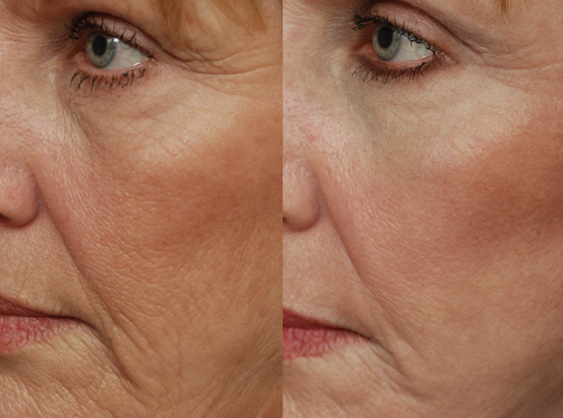 Láser fraccionado de CO2 Medelín1