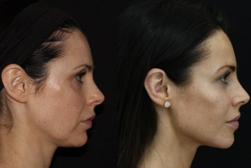 Moldeamiento de volumenes faciales en Medellin1