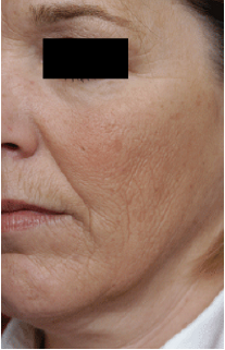Peeling en Medellin Colombia 01