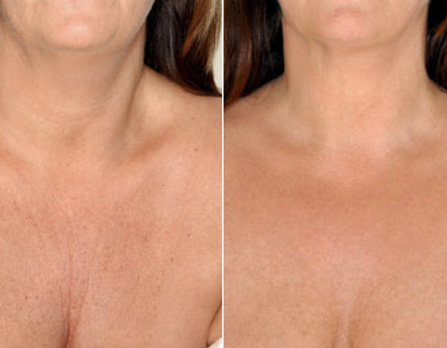 Restylane vital Medellin 08