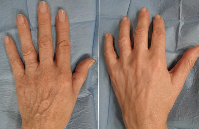 Restylane vital en Medellín