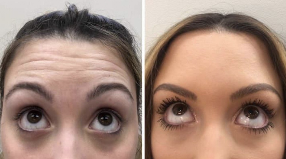 Toxina botulínica Medellín